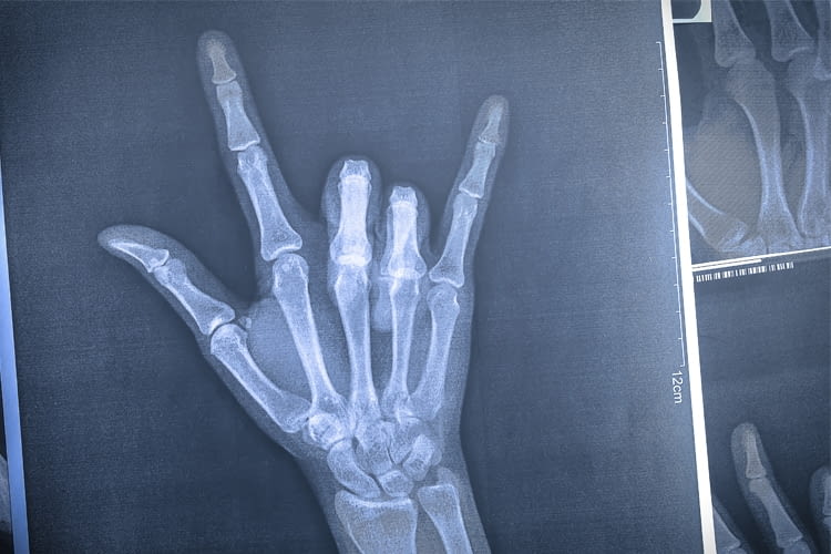 In Zukunft könnte der Handschuh auch Menschen helfen, denen Teile der Hand fehlen In Zukunft könnte der Handschuh auch Menschen helfen, denen Teile der Hand fehlen